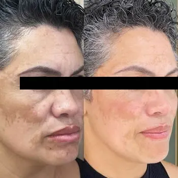 melasma-rosto.webp